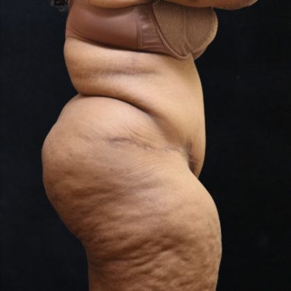 Post Weight Loss Before & After Patient #11517