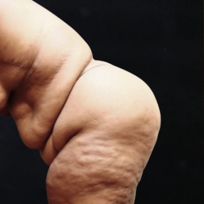 Post Weight Loss Before & After Patient #11517