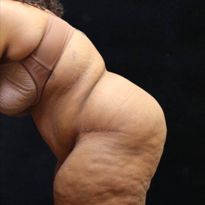Post Weight Loss Before & After Patient #11517