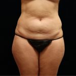 Tummy Tuck Before & After Patient #11523
