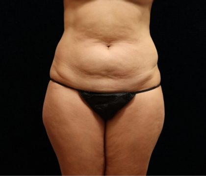 Tummy Tuck Before & After Patient #11523