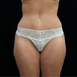Tummy Tuck Before & After Patient #11523