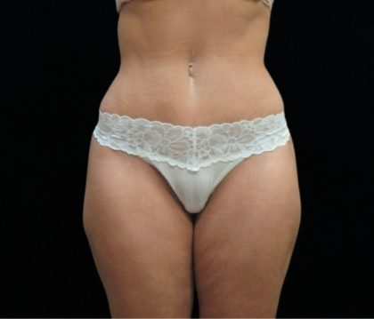 Tummy Tuck Before & After Patient #11523