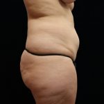 Tummy Tuck Before & After Patient #11523