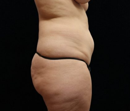 Tummy Tuck Before & After Patient #11523