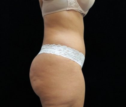 Tummy Tuck Before & After Patient #11523