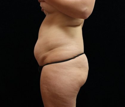 Tummy Tuck Before & After Patient #11523