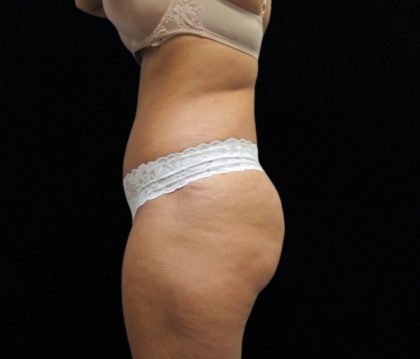 Tummy Tuck Before & After Patient #11523