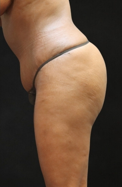 Tummy Tuck Before & After Patient #11524