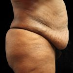 Tummy Tuck Before & After Patient #11524