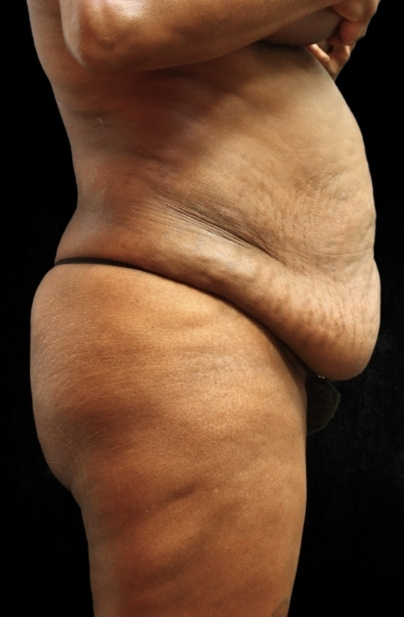 Tummy Tuck Before & After Patient #11524