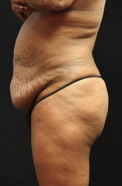 Tummy Tuck Before & After Patient #11524