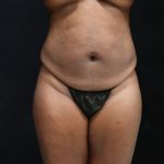 Tummy Tuck Before & After Patient #11525