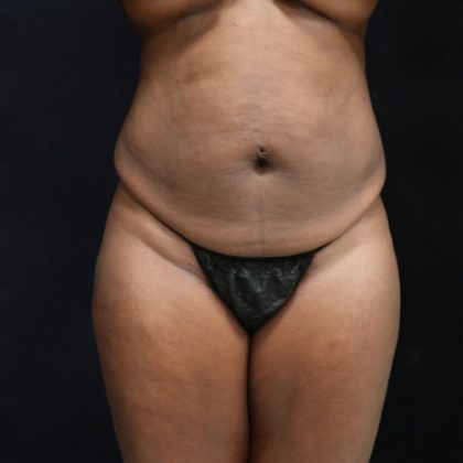 Tummy Tuck Before & After Patient #11525