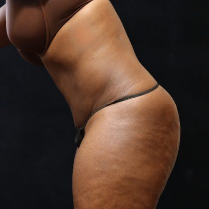 Tummy Tuck Before & After Patient #11525