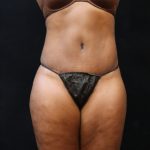 Tummy Tuck Before & After Patient #11525