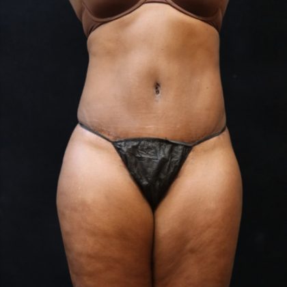 Tummy Tuck Before & After Patient #11525