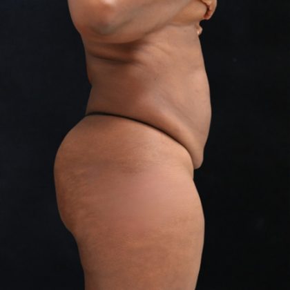 Tummy Tuck Before & After Patient #11525