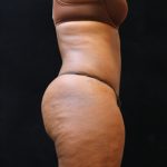 Tummy Tuck Before & After Patient #11525