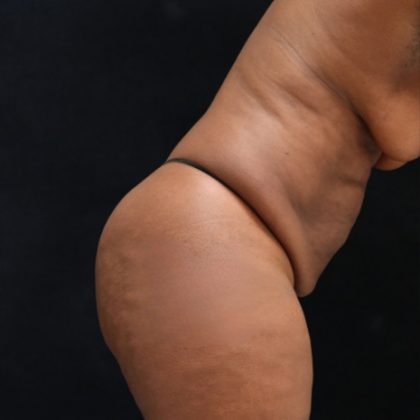 Tummy Tuck Before & After Patient #11525
