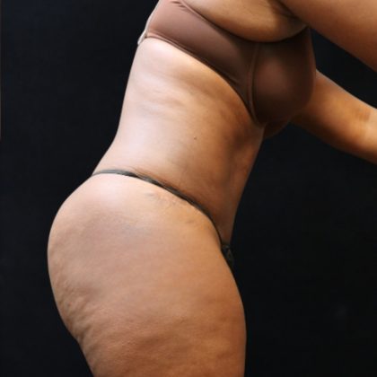 Tummy Tuck Before & After Patient #11525