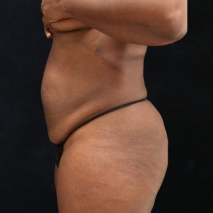 Tummy Tuck Before & After Patient #11525