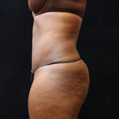 Tummy Tuck Before & After Patient #11525