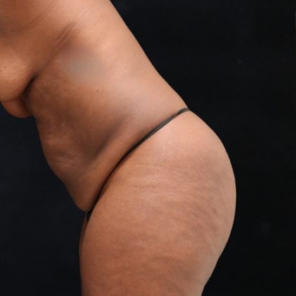 Tummy Tuck Before & After Patient #11525