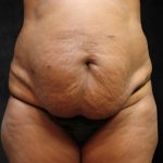 Tummy Tuck Before & After Patient #11526