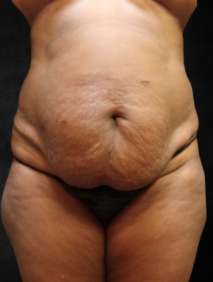 Tummy Tuck Before & After Patient #11526