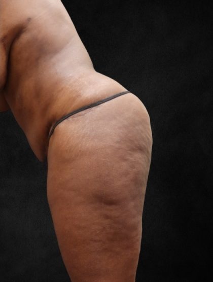 Tummy Tuck Before & After Patient #11526