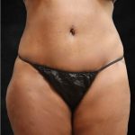 Tummy Tuck Before & After Patient #11526