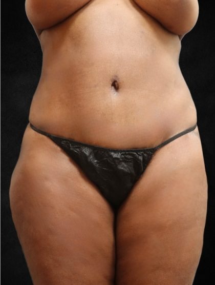 Tummy Tuck Before & After Patient #11526