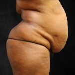Tummy Tuck Before & After Patient #11526