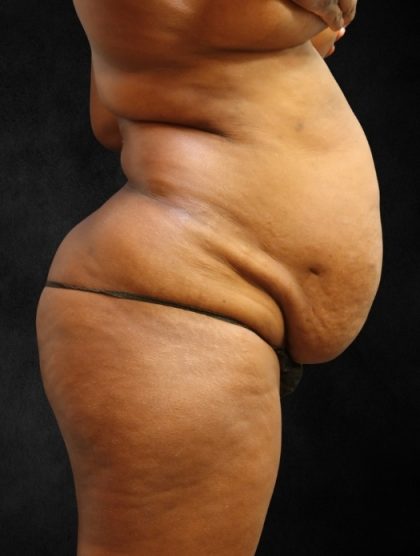 Tummy Tuck Before & After Patient #11526