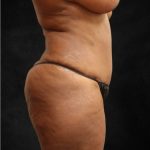 Tummy Tuck Before & After Patient #11526