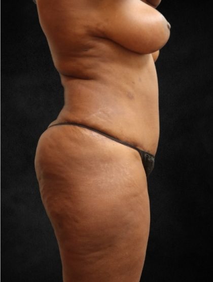 Tummy Tuck Before & After Patient #11526