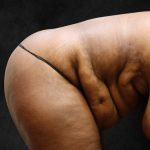 Tummy Tuck Before & After Patient #11526