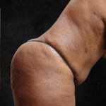 Tummy Tuck Before & After Patient #11526