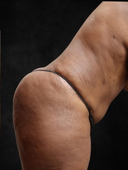 Tummy Tuck Before & After Patient #11526