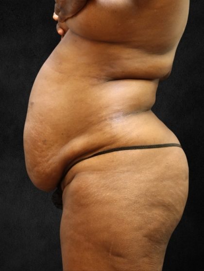 Tummy Tuck Before & After Patient #11526