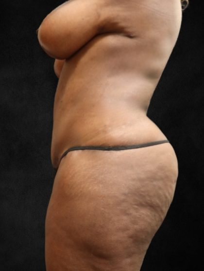 Tummy Tuck Before & After Patient #11526