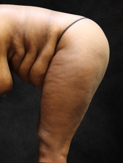 Tummy Tuck Before & After Patient #11526