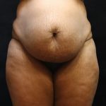 Tummy Tuck Before & After Patient #11527