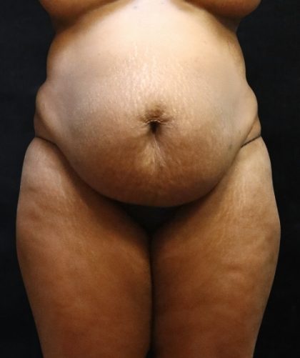 Tummy Tuck Before & After Patient #11527