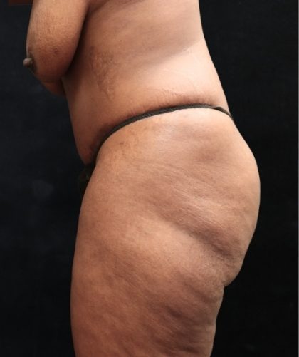 Tummy Tuck Before & After Patient #11527