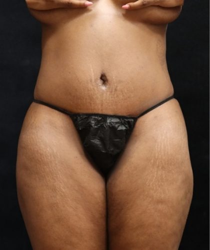 Tummy Tuck Before & After Patient #11527