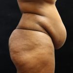 Tummy Tuck Before & After Patient #11527