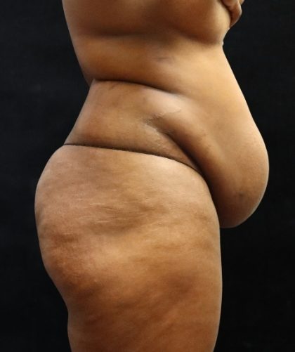Tummy Tuck Before & After Patient #11527