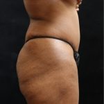 Tummy Tuck Before & After Patient #11527